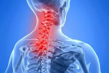best hospital for cervical spondylitis treatment in purnia, best doctor for cervical spondylitis treatmen in purnia, cost of cervical spondylitis treatmen in purnia