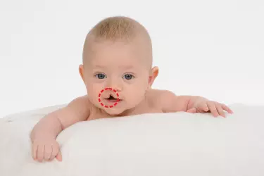 best hospital for cleft lip palate surgery in Purnia, best doctor for cleft lip palate surgery in Purnia, cost of cleft lip palate surgery in Purnia