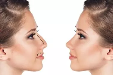 best hospital for septoplasty surgery in purnia, best doctor for septoplasty surgery in purnia, cost of septoplasty surgery in purnia